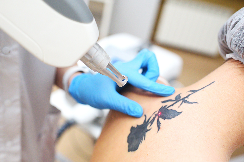 Best Safe & Effective Tattoo Removal in Rawalpindi