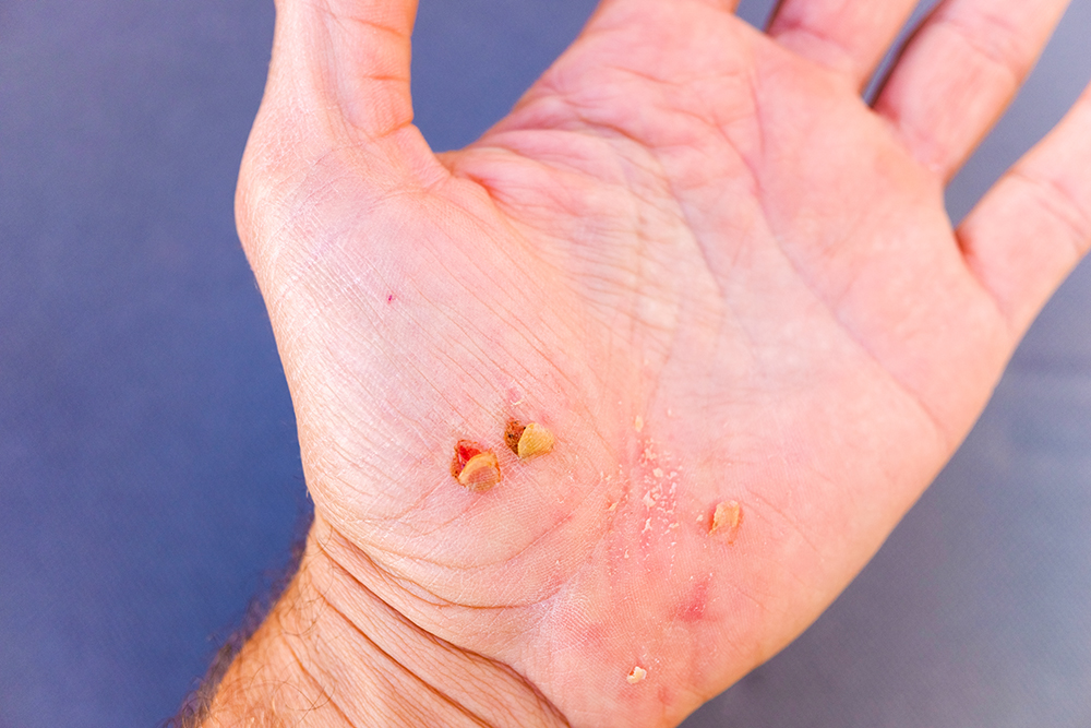 Expert Warts Removal Services in Rawalpindi